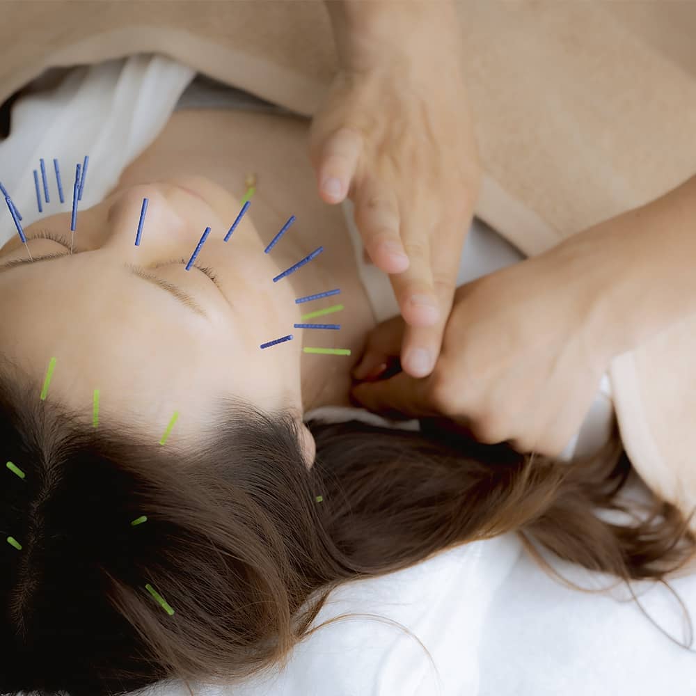 素肌再生プログラムはお客様のお肌に合わせたオーダーメイドの美容鍼を施術します